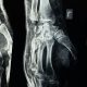 AI chat helps avoid surgery: Elon Musk’s Grok identifies teenage girl’s wrist fracture after doctors fail to diagnose it